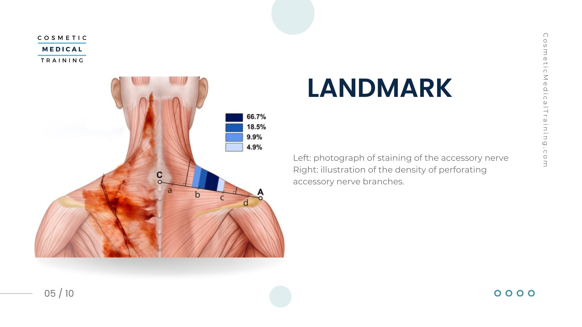Trap Tox; Botox Injection Technique Into the Trapezius Muscles